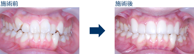 審美歯科のbefore after