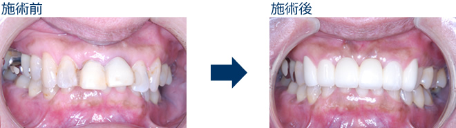審美歯科のbefore after