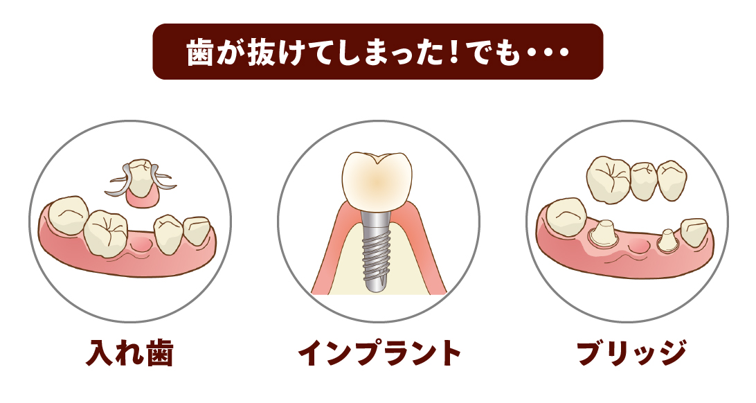 歯が抜けた後の治療方法